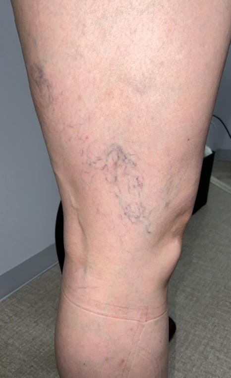 細絡（さいらく）は治療すべき？